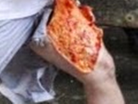 Idoso pode perder a perna após ser internado em Hospital de São Francisco do Conde